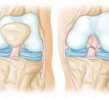 Anatomia articulației genunchiului. Genți de articulație a genunchiului