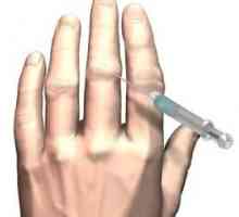 Artrita degetelor: tratament, cauze, simptome