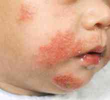 Dermatita atopica la un copil: tratament si simptome
