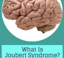 Boala la nivelul geneticii - sindromul lui Joubert
