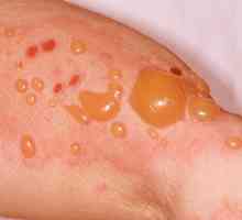 Dermatita buloasă: cauze, simptome, diagnostic și tratament