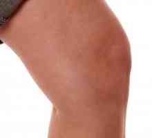 Ceea ce se caracterizează prin tratamentul sinovitisului articulației genunchiului?