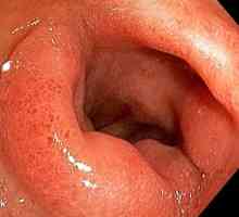 Care este simptomul ulcerului duodenal din simptomul unui ulcer gastric?
