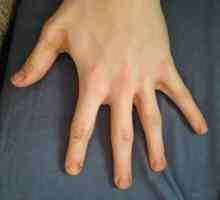 Cheshutya mâinile între degete: cauzele și tratamentul
