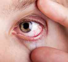 Ochiul demodectic: cauze, simptome și caracteristici de tratament