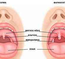Faringita și laringita: diferențe, simptome și metode de tratament