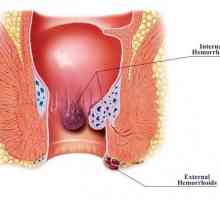 Hemoroizi: cauze ale bărbaților, simptome și caracteristici de tratament