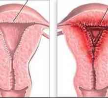 Hiperplazia endometrului: ce este? Cauze, simptome și metode de tratament