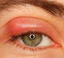 Unguent de ochi de la inflamarea pleoapelor: recenzii ale medicilor