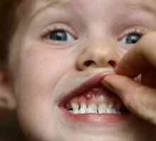 Ulcere pe gingiile din copil: cauze și tratament