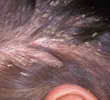 Pielea capului fungic: simptome și tratament