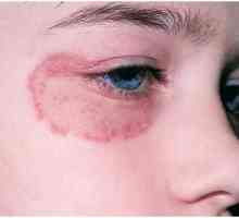 Ciuperca pe față: tipuri, cauze și tratament