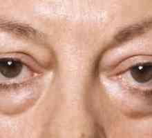 Hernia sub ochi: cum să scăpați fără intervenție chirurgicală, cum să eliminați și să vă recomandați