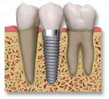 Implanturile dinților: recenzii ale pacienților despre operație