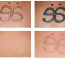Scapa de greșelile din trecut: îndepărtarea cu laser a tatuajelor