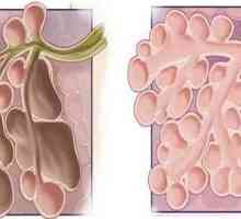 Emfizemul plămânilor - ce este? Cauze, simptome și metode de tratament