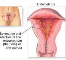 Endometrita uterului - ce este? Simptomele endometritelor la femei. Ginecologie - endometrita