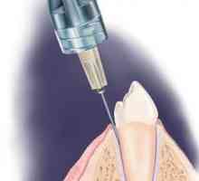 Cum acționează Ultracaine în stomatologie?