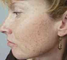 Cum să eliminați pete de pigment pe față: remedii populare