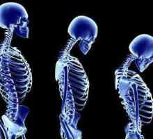 Care doctor trateaza osteoporoza? Osteoporoza: simptome, cauze, tratament și prevenire