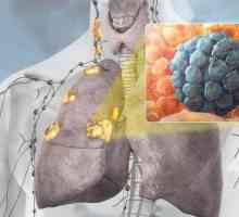 Carcinom pulmonar: simptome, etape, tratament, prognostic