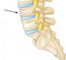 Fractura de compresie a coloanei vertebrale la un copil: simptome, tratament