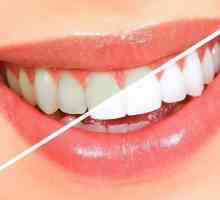 Laminarea dinților: o descriere a procedurii, recenzii