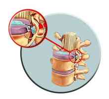 Tratamentul herniei vertebrale: tehnici de bază