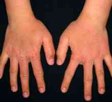 Unguent de la eczeme pe mâini: auto-tratamentul este periculos!