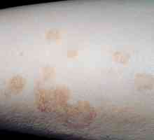 Eczema microbiană: cauze, simptome, diagnostice și trăsături de tratament