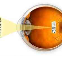 Micopia ochiului: simptome, cauze, diagnostic și tratament