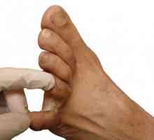 Porumbul între degetele de la picioare: tratamentul cu medicamentele folclorice. Cale uscate între…
