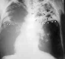 Perioada de incubație a tuberculozei este periculoasă?