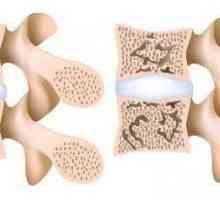 Osteoporoza coloanei vertebrale: simptome și tratament cu medicamente populare
