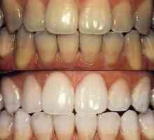 Albirea dinților: tipurile de procedură și caracteristicile comportamentului acesteia