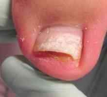 Detașarea unghiilor pe degetele mari: motive și trăsături de tratament