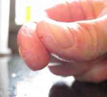 Degetele de pe mâini crack: cauze și tratament