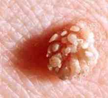 Papilloma pe anus: cauze și metode de tratament. Remedii populare pentru papilomi