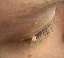 Papilloma pe ochi. Cauze de papilom pe pleoapă și metode de îndepărtare