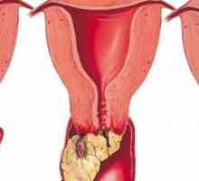 Papilome în vagin: metode de tratament