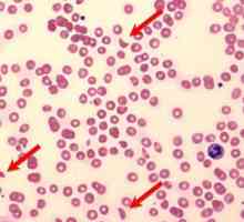 Hemoliza hematologică a sângelui: cauze, simptome și metode de tratament