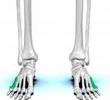 Fractura de 5 oase metatarsale ale piciorului: diagnosticare, reabilitare, previziuni