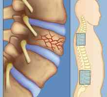 Fractura coloanei vertebrale. Tratamentul fracturii vertebrale. Primul ajutor, chirurgie,…