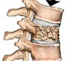 Fracturile coloanei vertebrale: tipuri și tratament