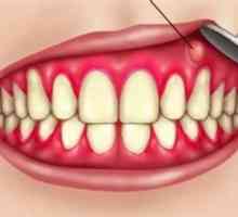 Periostitisul dintelui: tipuri, cauze, simptome și tratament