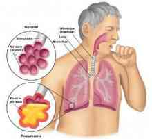 Pneumonia interstițială: cauze, tratament, complicații