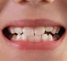 Mobilitatea dinților: grad, cauze, tratament