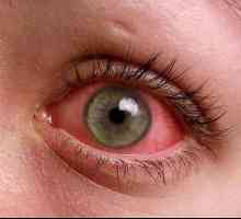 Roșeața ochilor la copii: cauzele și modalitățile de tratament