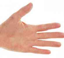 Roșeață și mâncărime pe mâini și picioare: tratament