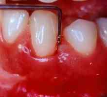 Consecințele unei igiene slabe: boala gingiilor